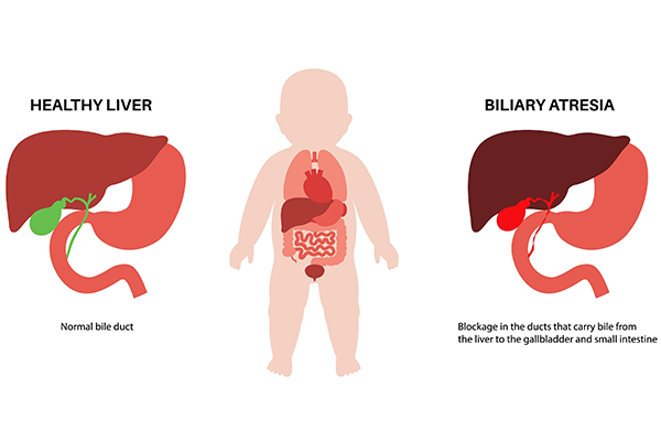 Understanding paediatric liver transplant